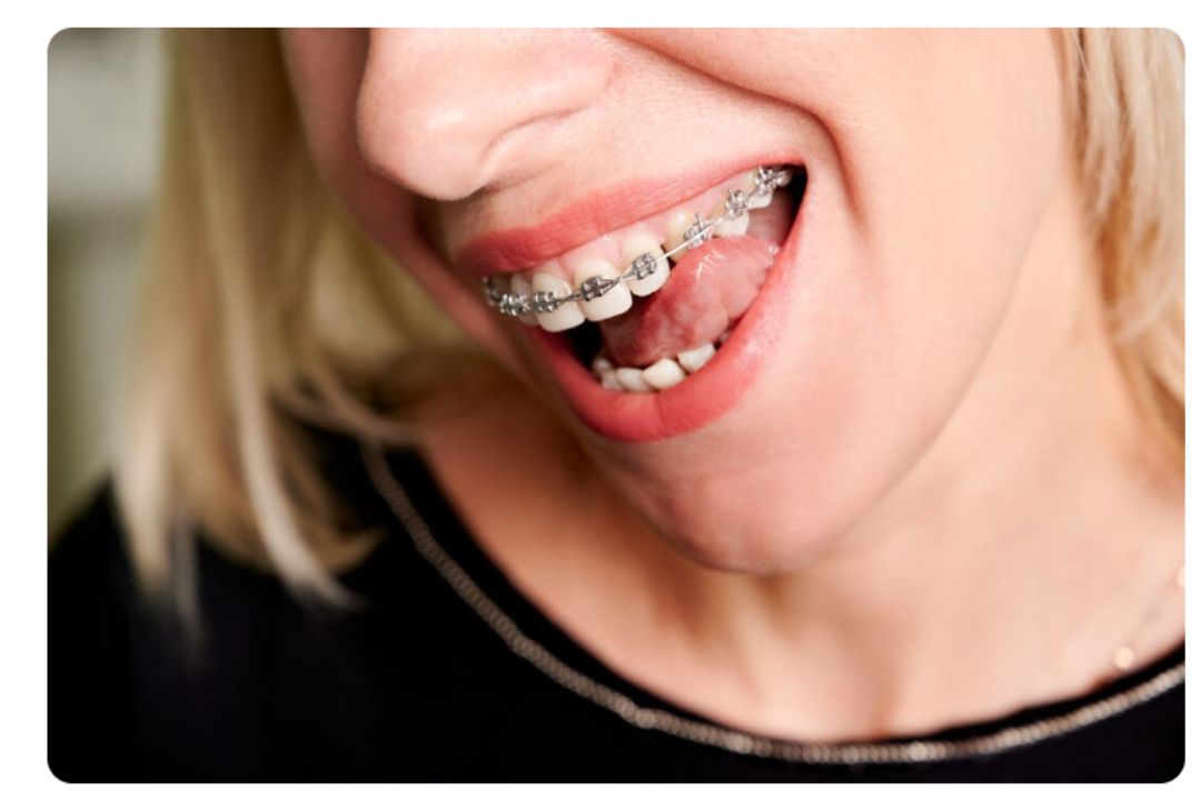 budget friendly teeth alignment braces costs in pune